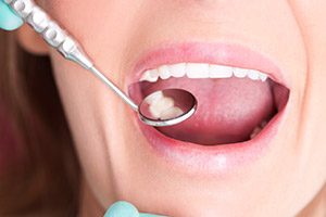Woman having teeth examined with dental mirror after metal free dental restoration