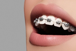 An up-close view of a person’s mouth who is wearing metal braces along the top row of teeth